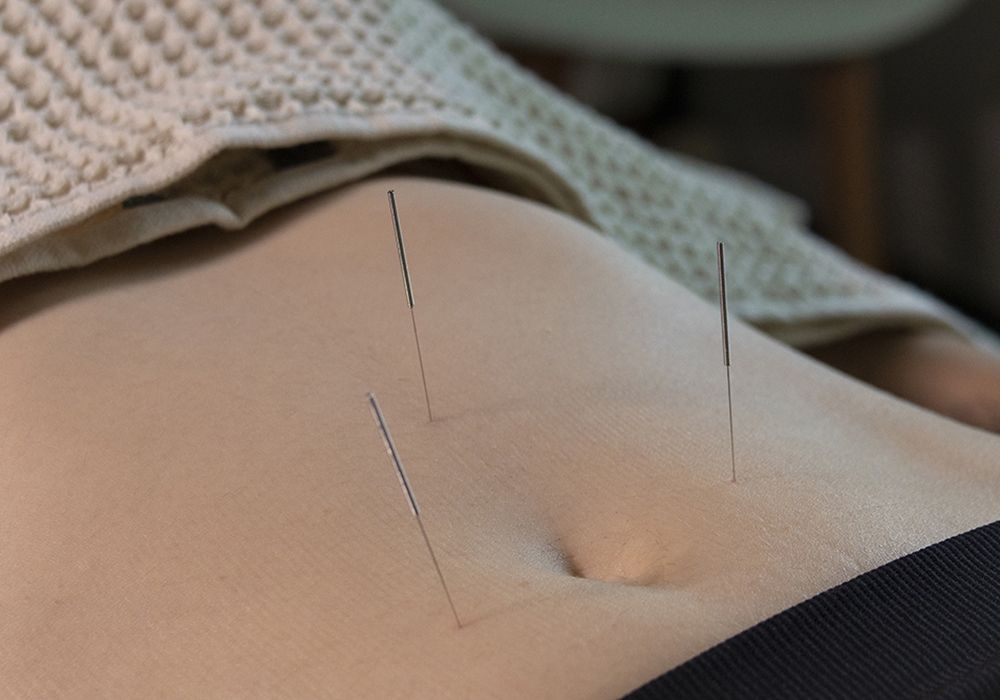 Ana Campo realizando un tratamiento de acupuntura.