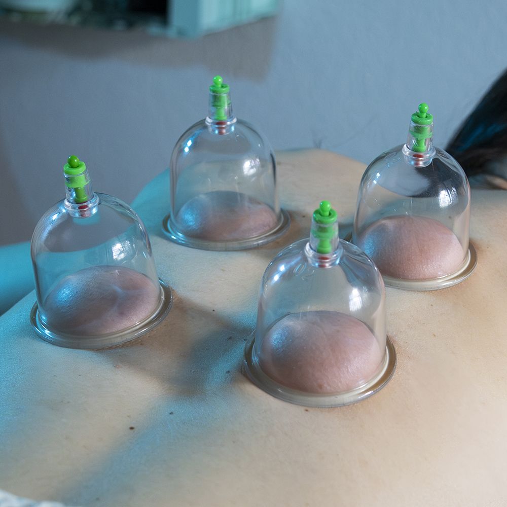 Ana Campo realizando el tratamiento con ventosas que muy utilizado en la Medicina Tradicional China.
